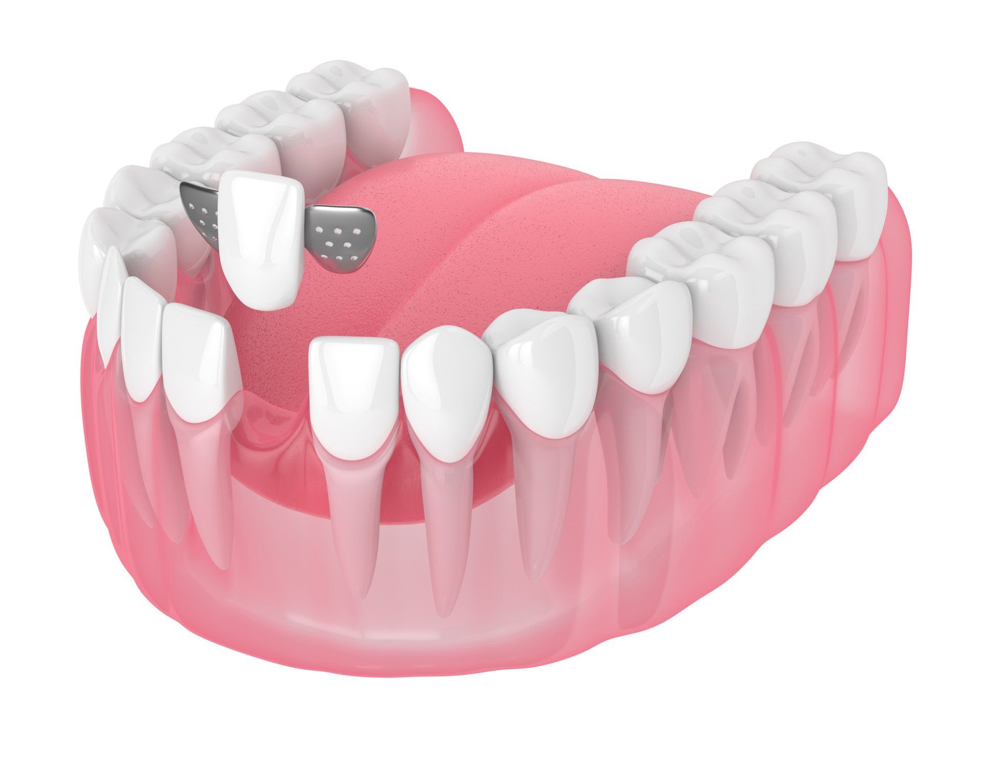 A bridge image by a dental implant service professional in Casper, Wy