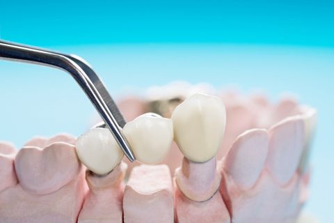 Dental Crown Placing | Casper, WY | Signature Dental