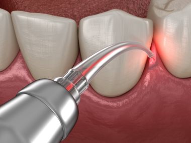 Teeth Frenectomy | Casper, WY | Signature Dental