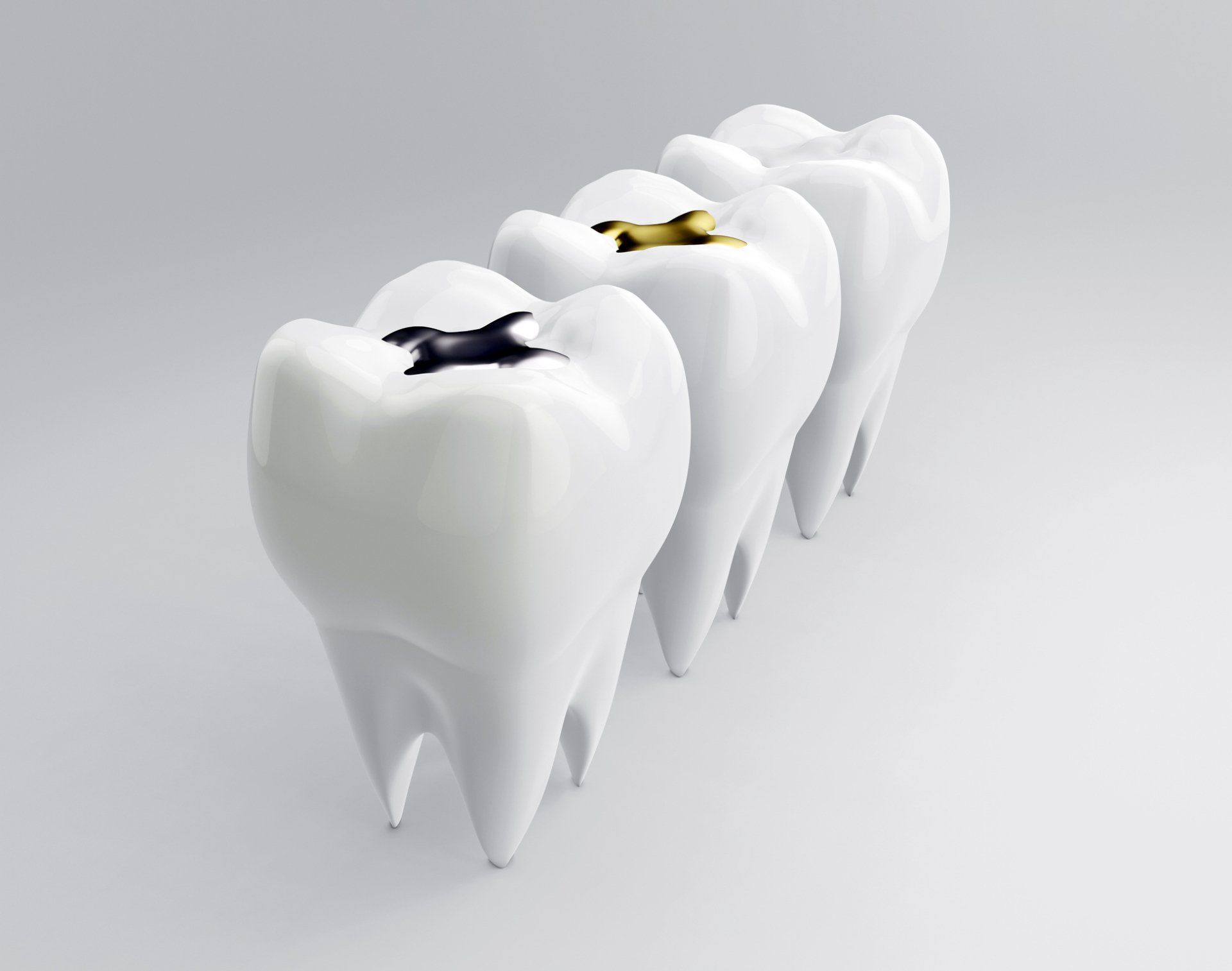Three Teeth with Different Sealant | Casper, WY | Signature Dental