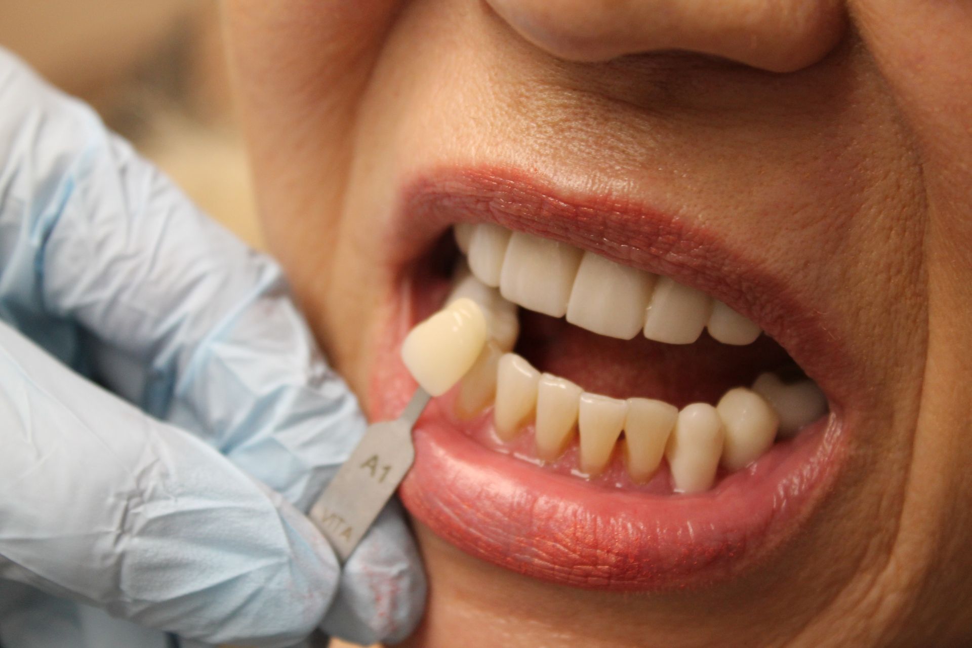 A woman is getting her teeth whitened by a dentist.