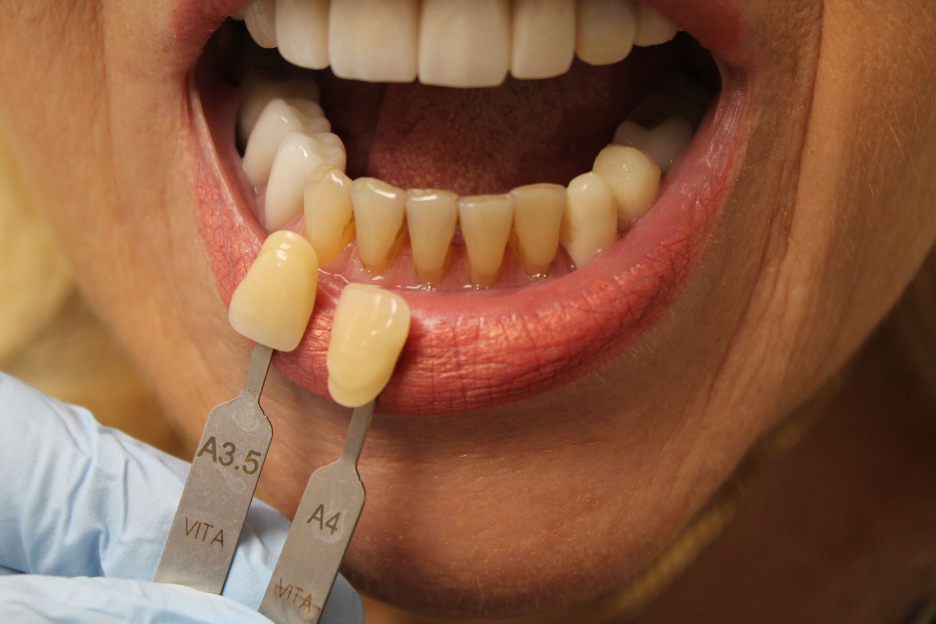 A woman is getting her teeth examined by a dentist.