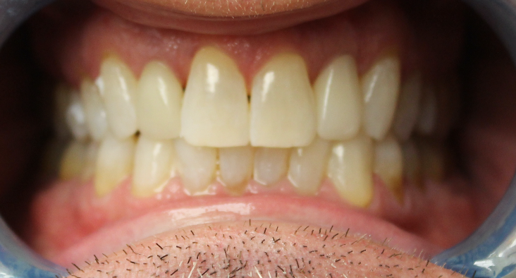 A close up of a man 's teeth with a beard.