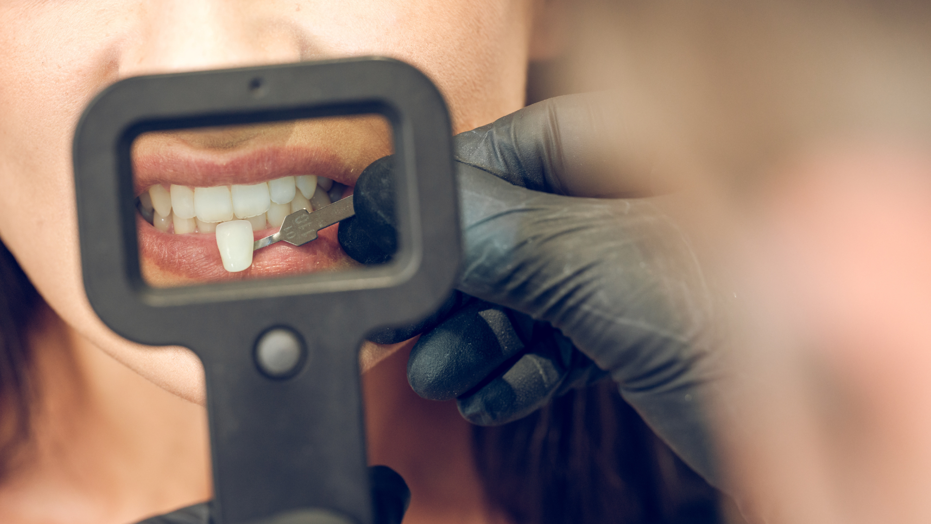 Why Do People Get Veneers: The Pros and Cons of Dental Veneers