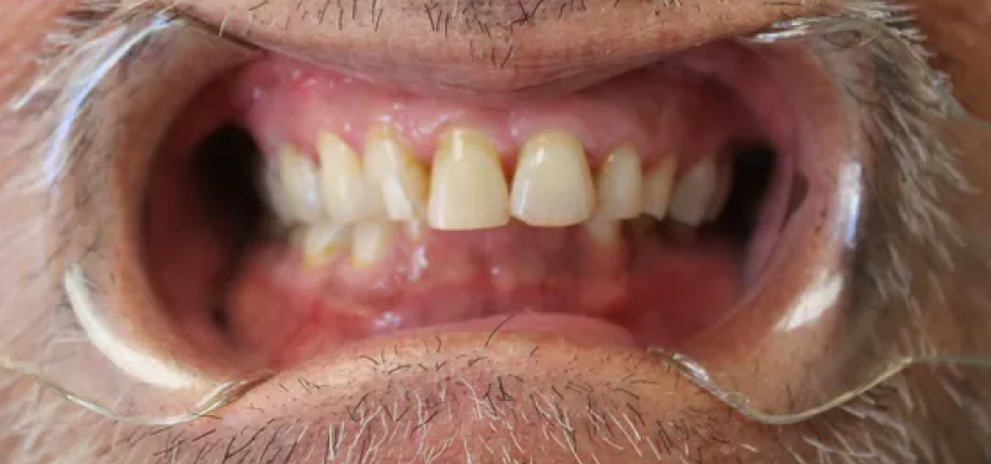 A close up of a man 's mouth with a clear mouth guard.