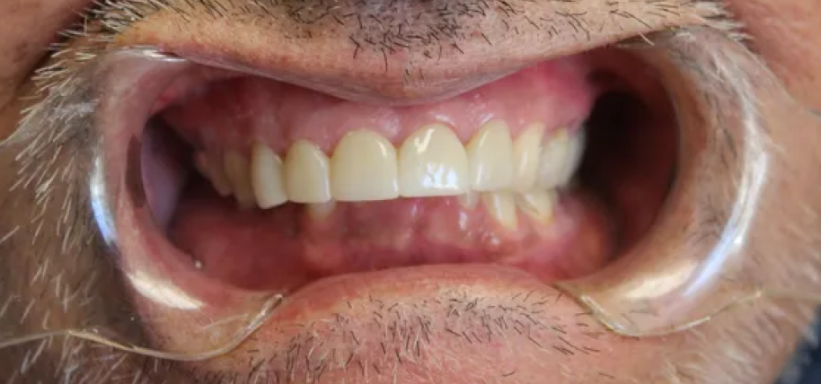 A close up of a man 's mouth with a plastic mouth guard.