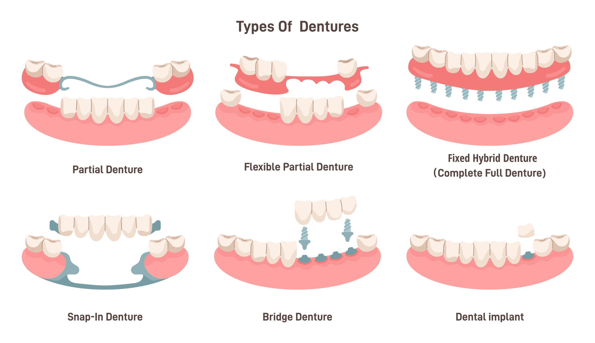 A diagram of different types of dentures on a white background.