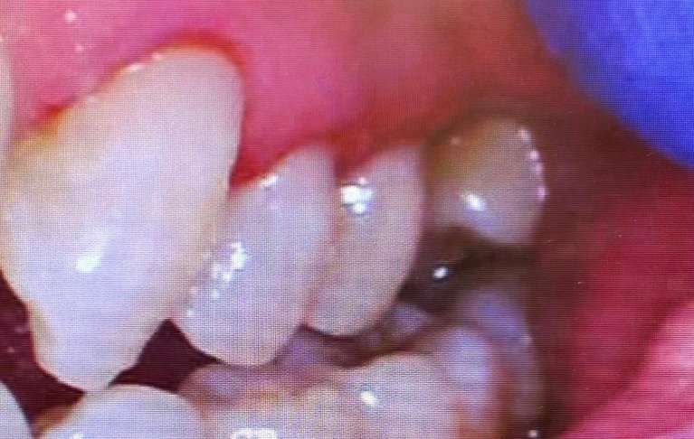 A close up of a person 's teeth with a blue glove on.