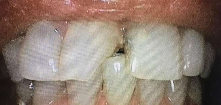 A close up of a person 's teeth with white teeth.