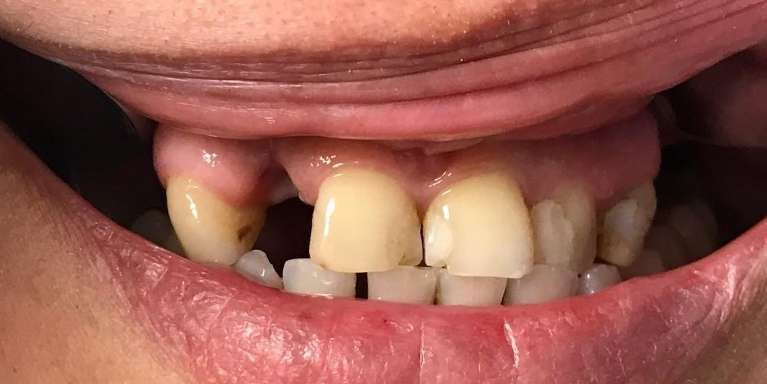 A close up of a person 's mouth with missing teeth.