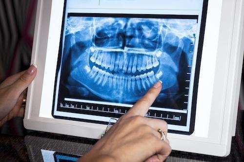 A person is pointing at an x-ray of a person 's teeth on a tablet.