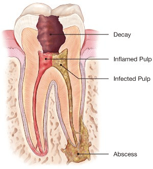 A diagram of a tooth with decay , inflamed pulp , infected pulp and abscess.