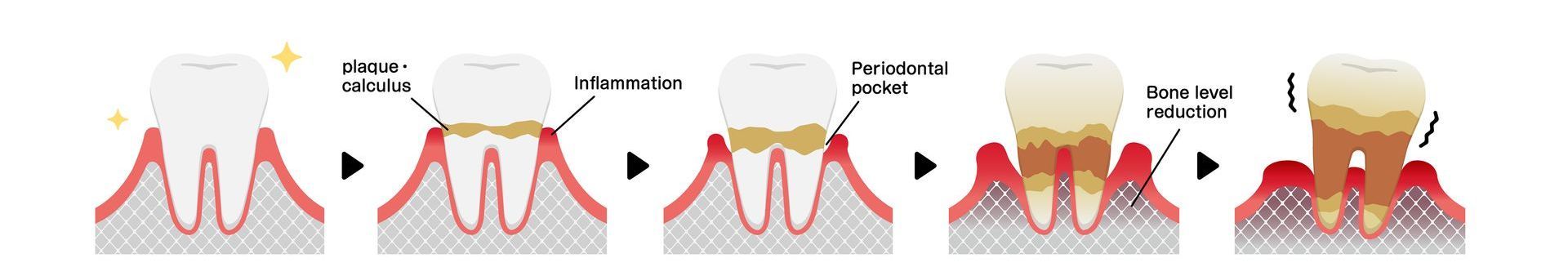 A diagram showing the stages of tooth decay.