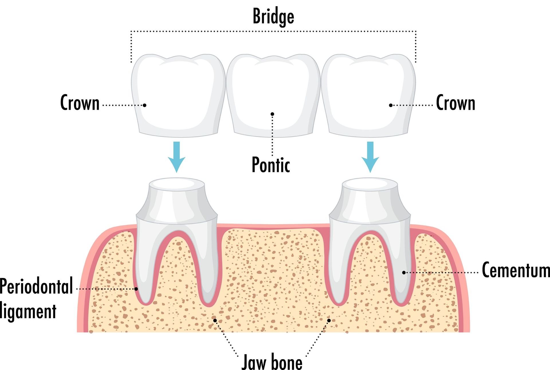 A diagram of a dental bridge with a crown and a pontic.