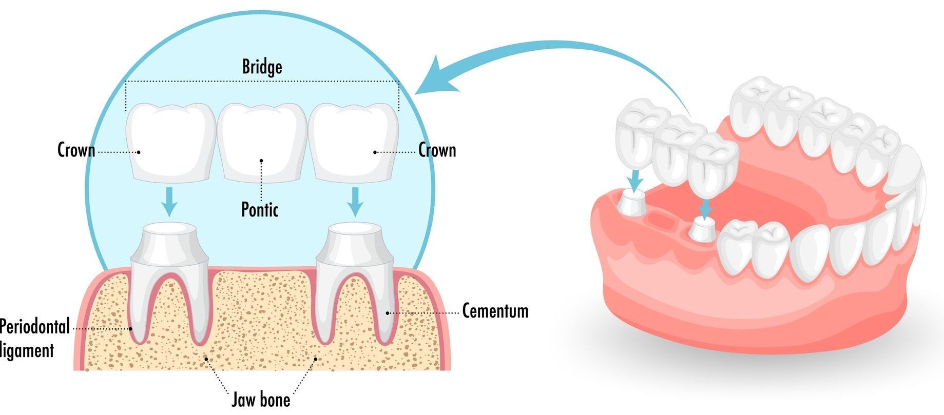 A diagram of a dental bridge and a picture of a denture.