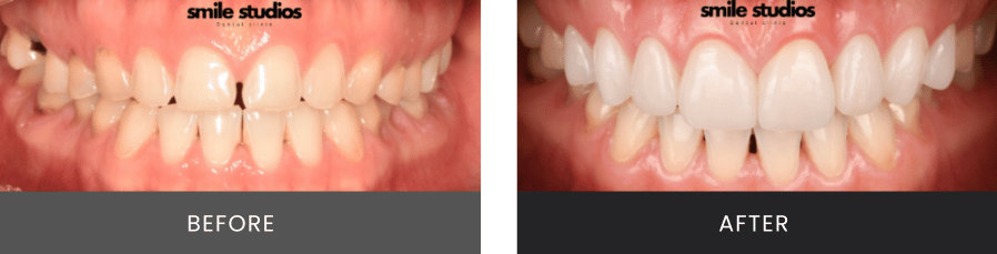 Smile X _ Improved shape, color, and tooth spac