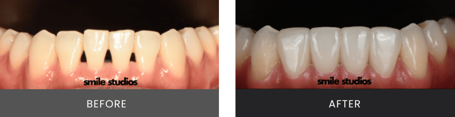 Smile Privé _ Shape, Color Improvement