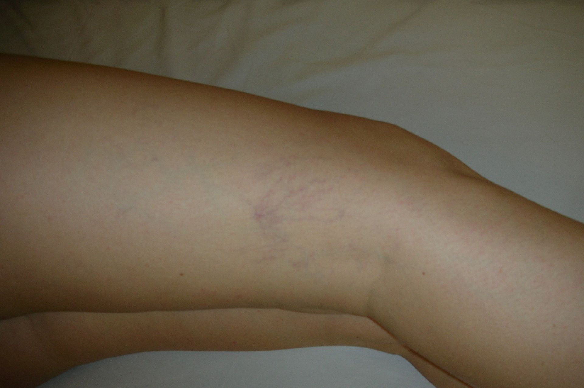 Diagnóstico y tratamiento de enfermedades venosas