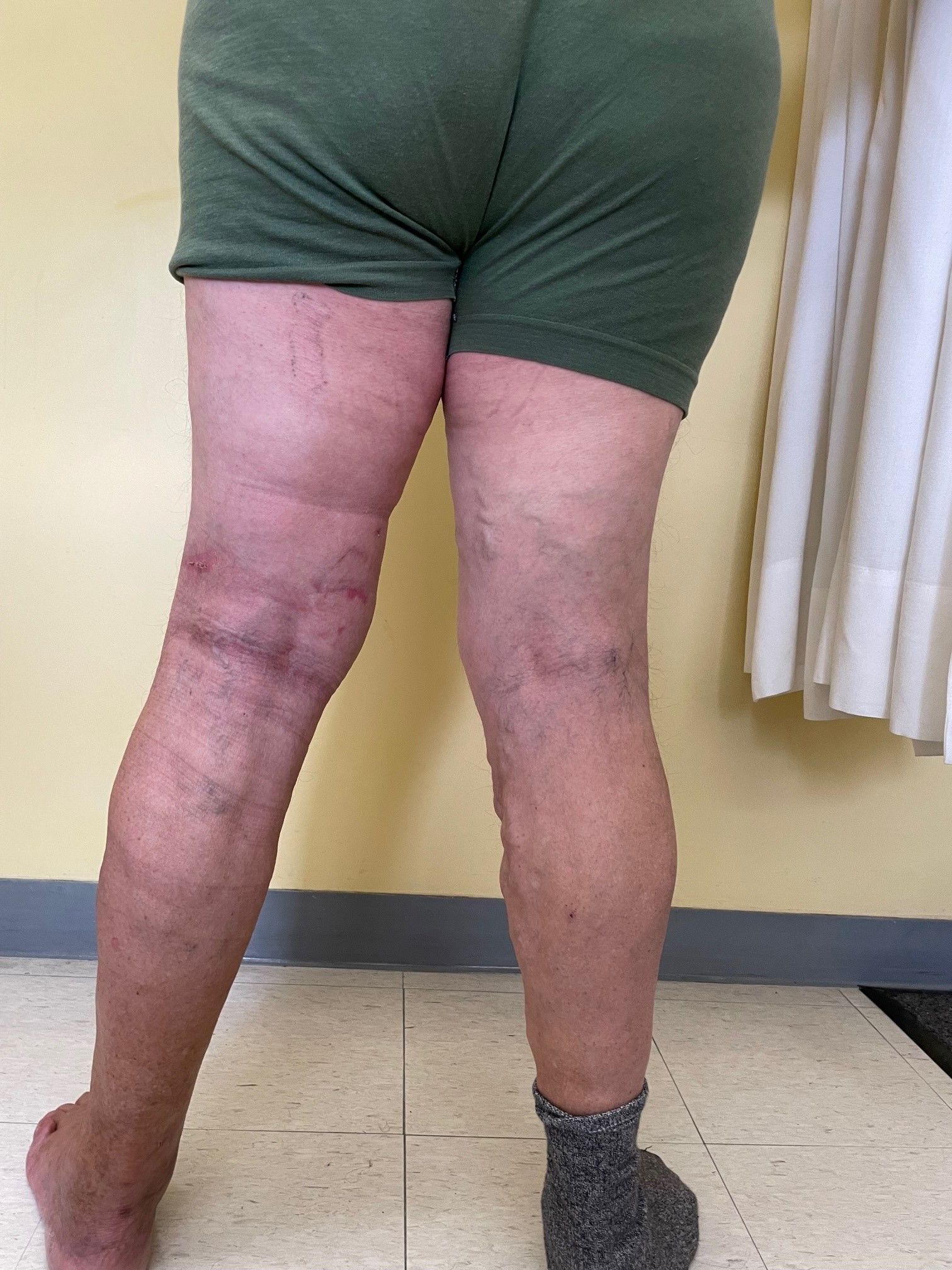 Flebología / Linfología