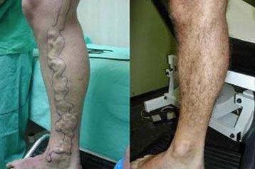 VARICES