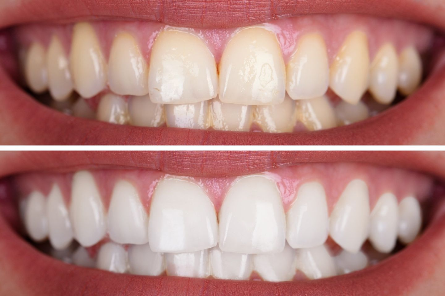 Woman's Teeth Before And After Whitening - Dental Treatments in Port Macquarie, NSW