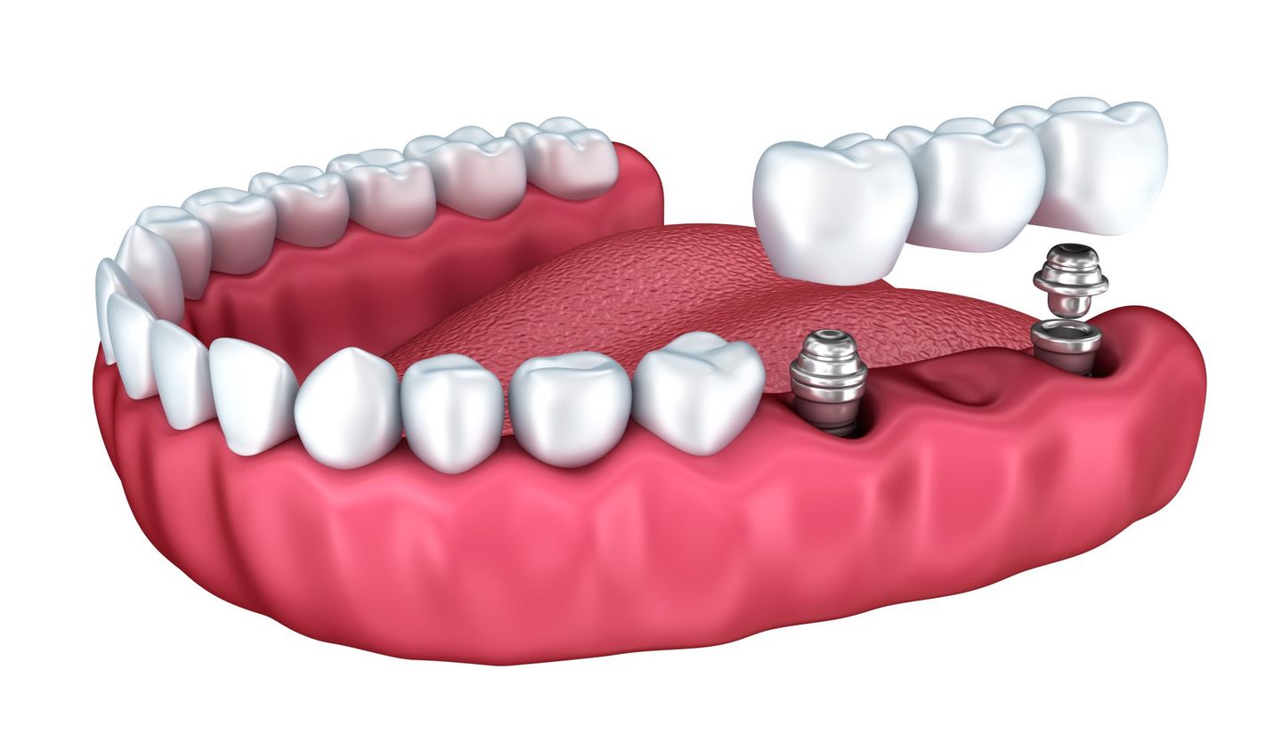 3d Lower Teeth And Dental Implant - Dental Treatments in Port Macquarie, NSW