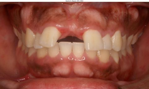 Model of teeth with braces on a white surface, with a blurred office background.