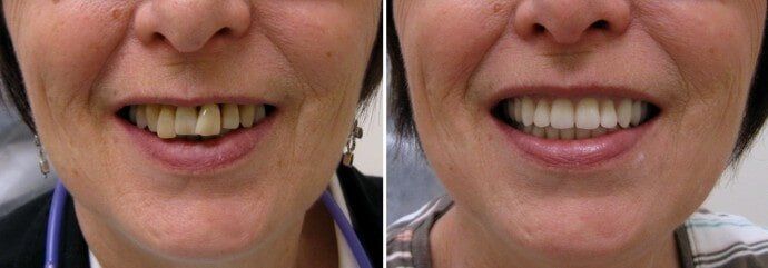 Before & After Dentures — Dental Services In Sarina, QLD