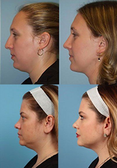 Surgical Results of Kybella — Norwood, MA — H2T Skin and Laser Center