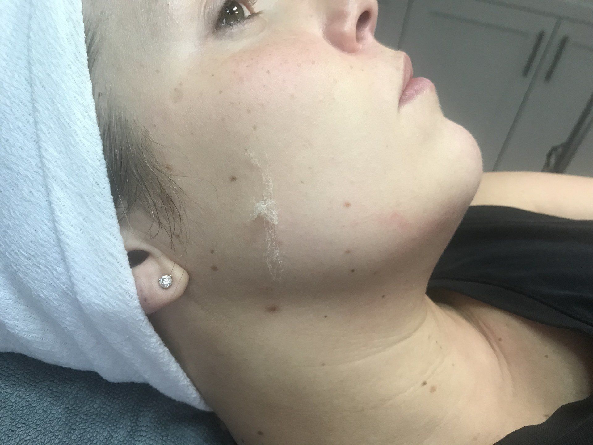 Dermaplaning