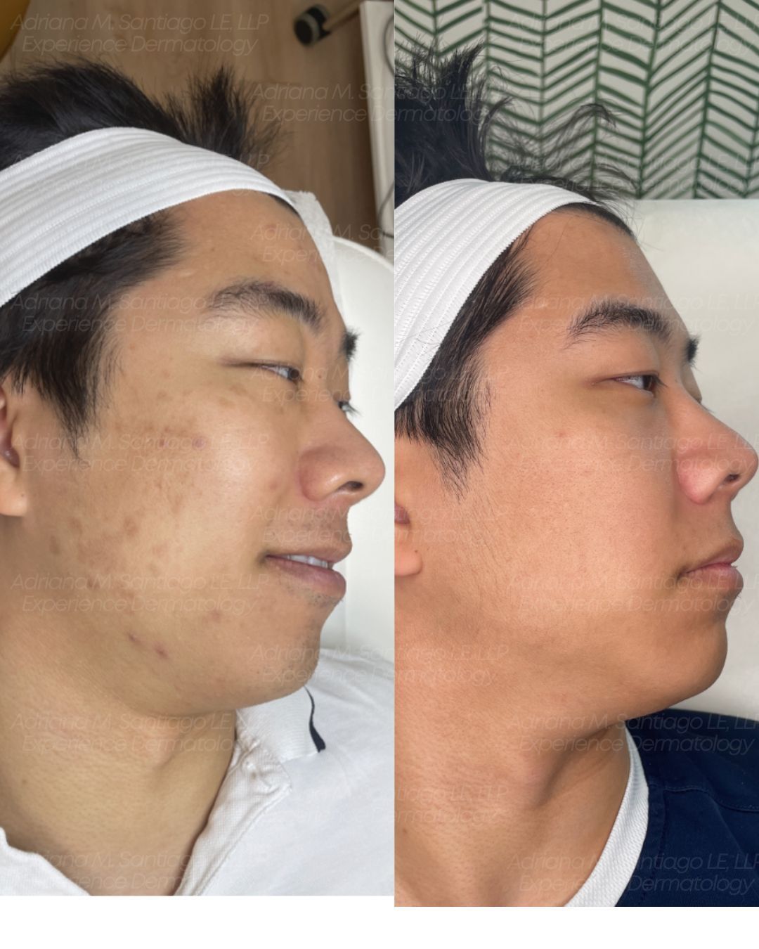 Person receiving facial treatment; cosmetician applying mask with brush.