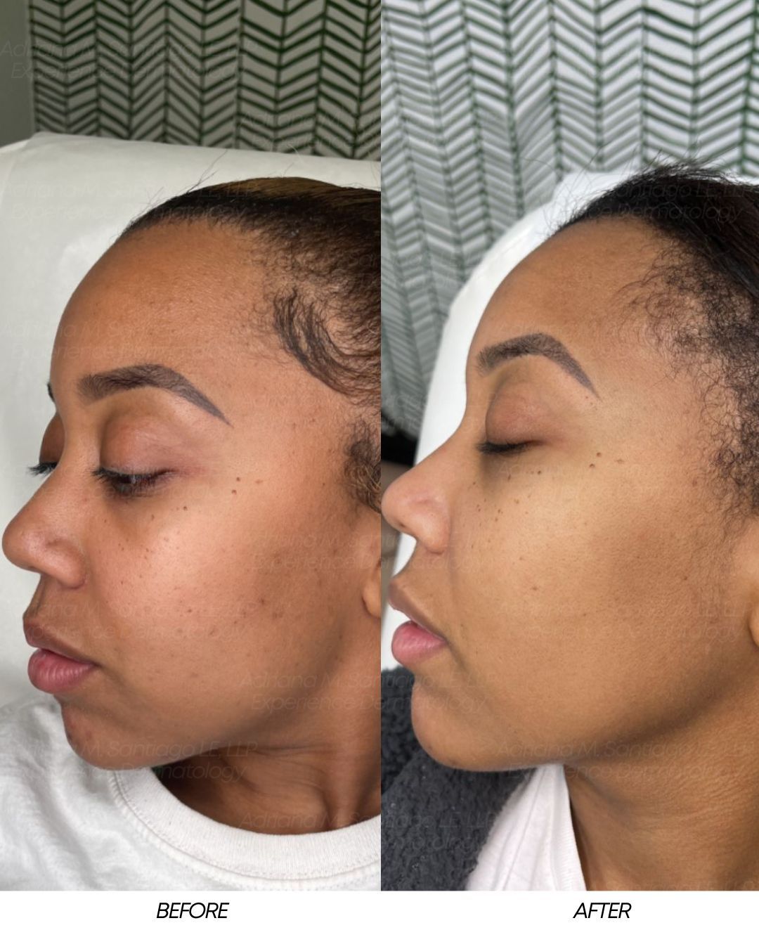 Woman getting lip tattoo. Black gloved hand using a tool. Eyes closed, lying down.