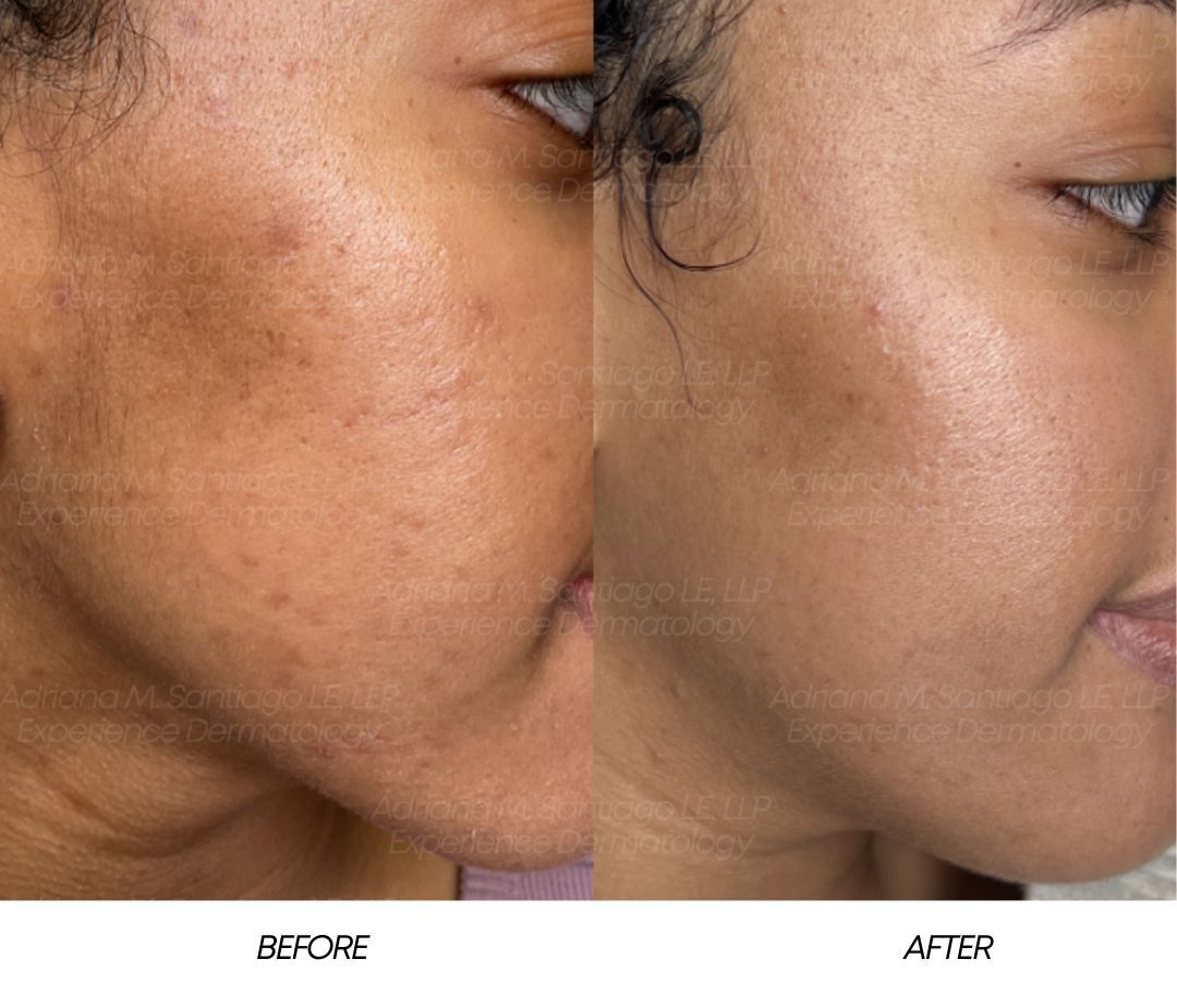 Woman receiving microneedling treatment on face in a spa, with hands in black gloves holding the device.