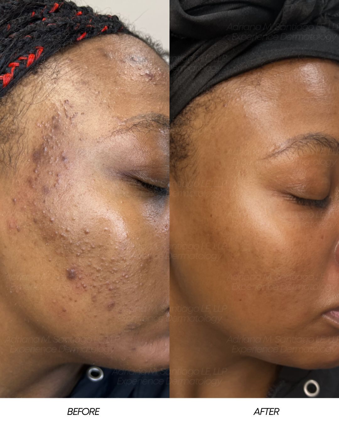 Woman receiving facial treatment in a spa, eyes closed. Therapist applies product with a brush.
