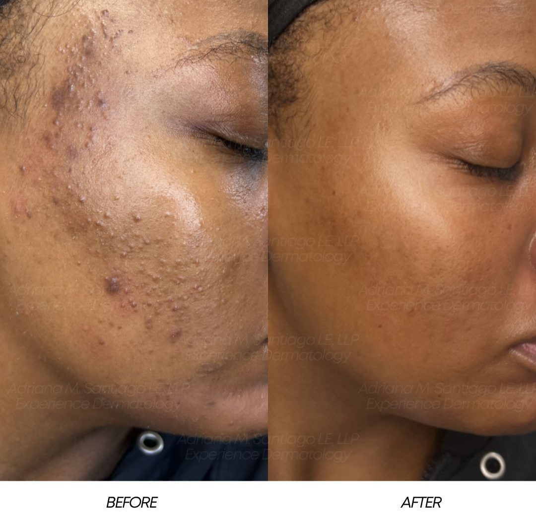 Woman receiving facial treatment in a spa, eyes closed. Therapist applies product with a brush.