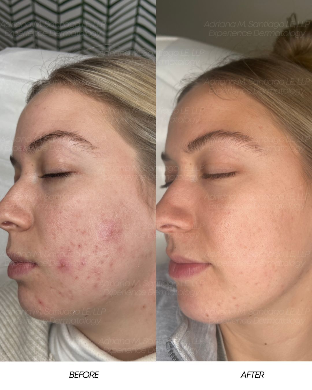 A medical professional injecting filler into a patient's forehead. Both are in a clinic setting.