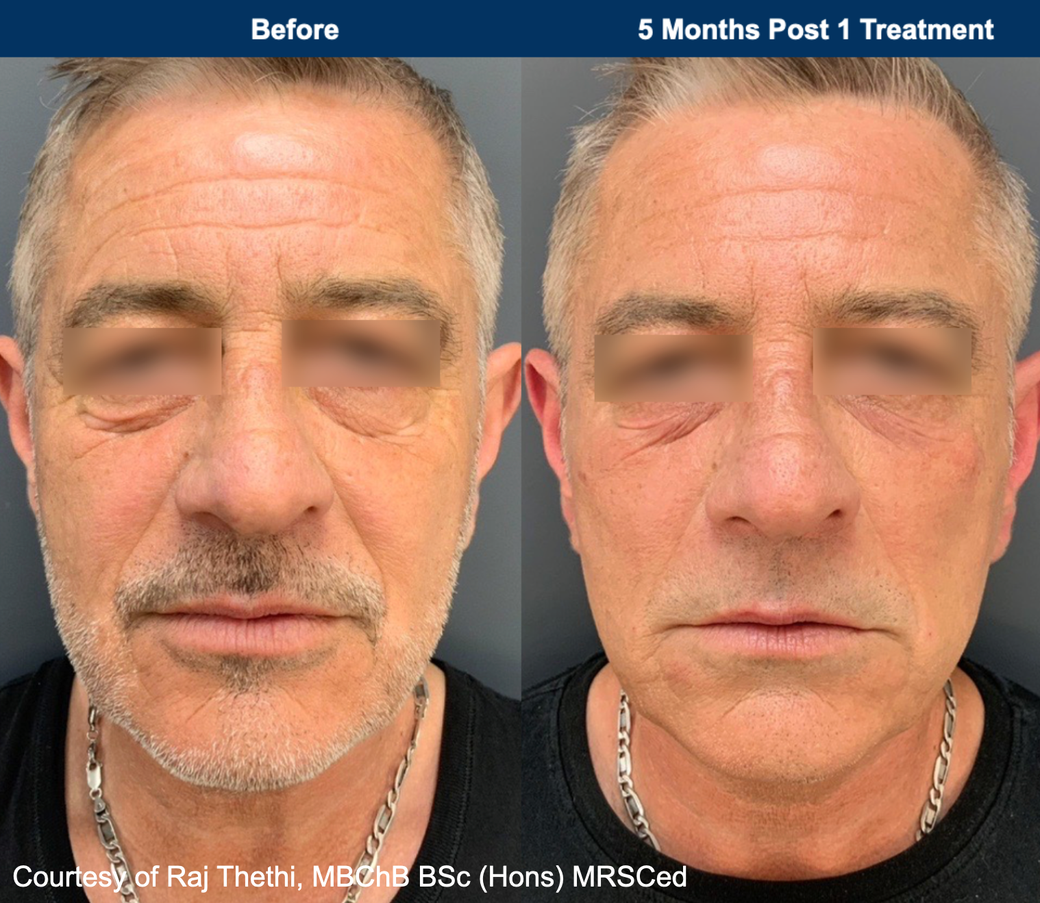 A person looking in a mirror, squeezing a pimple on their chin in a bathroom.