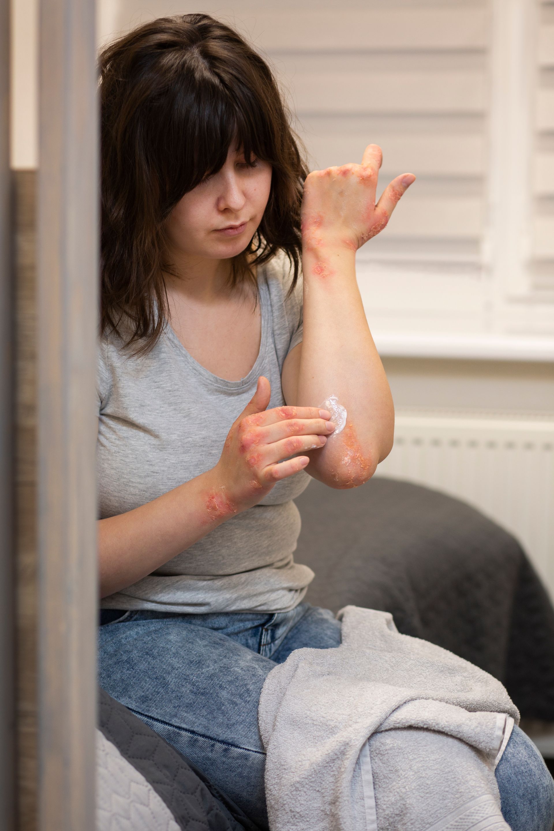 Woman applying cream to red, irritated skin on her elbow.