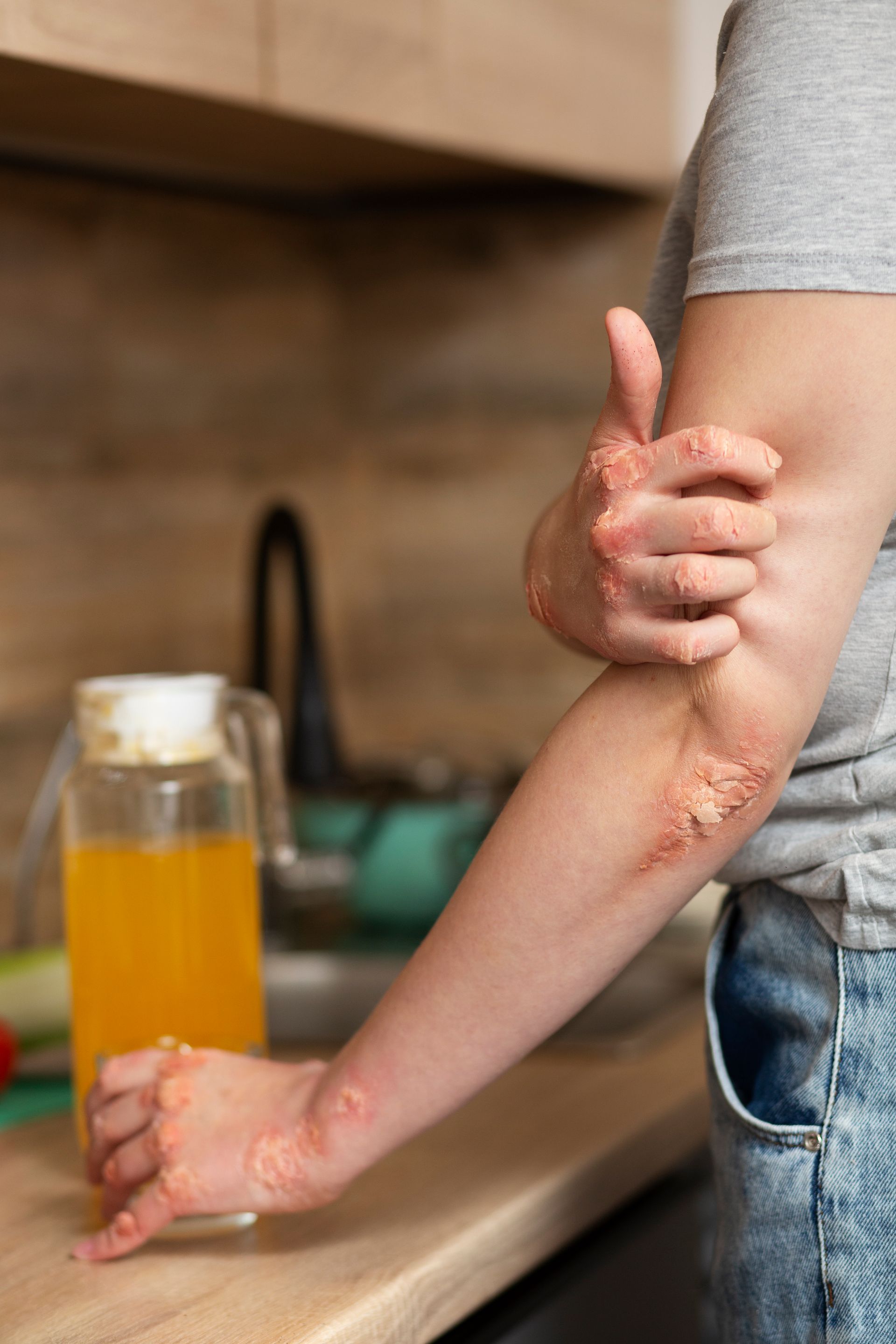 Person with irritated, red skin on arm and hand in kitchen, near a jug of juice.
