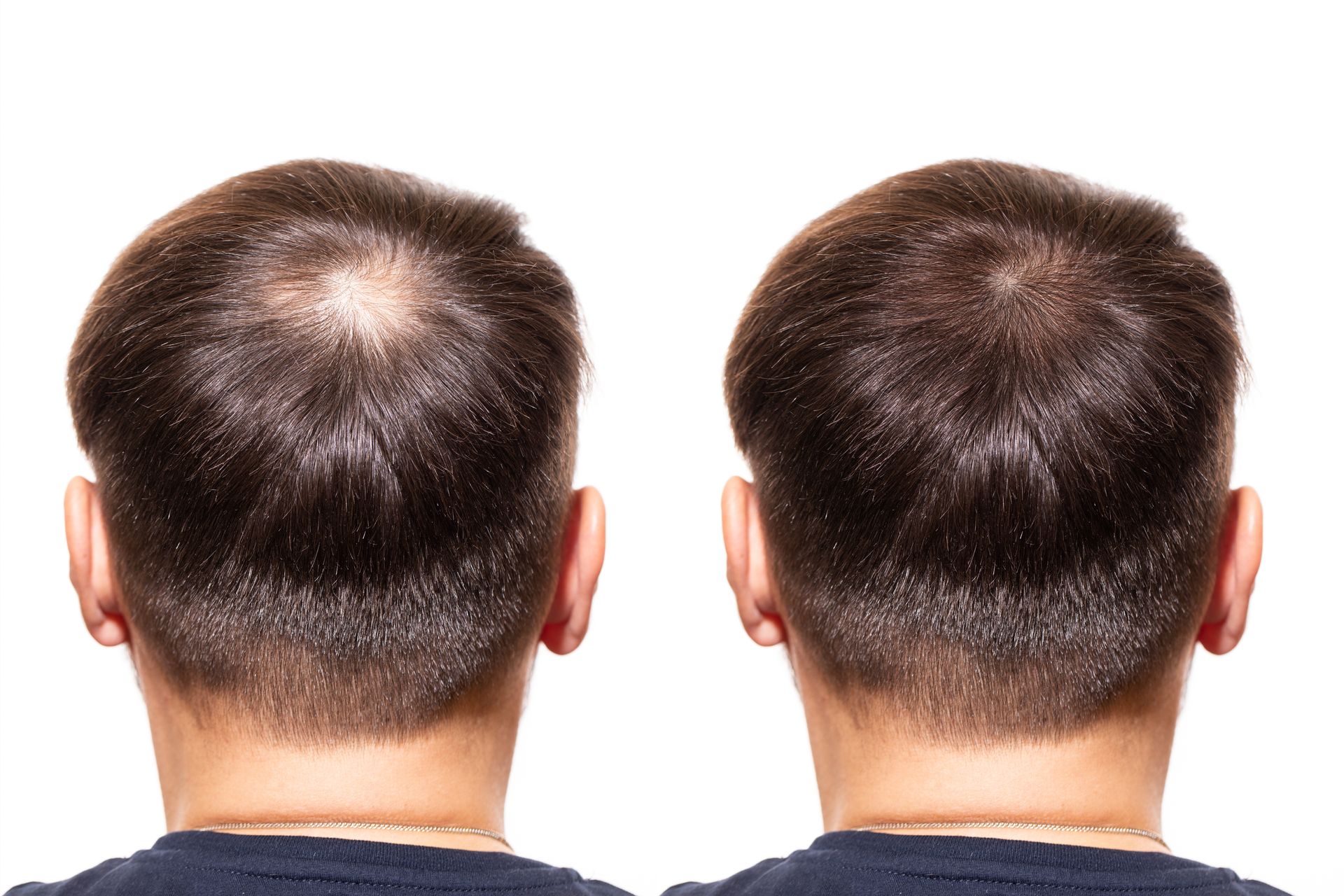 Comparison of a person's head with thinning hair (left) and fuller hair after treatment (right).