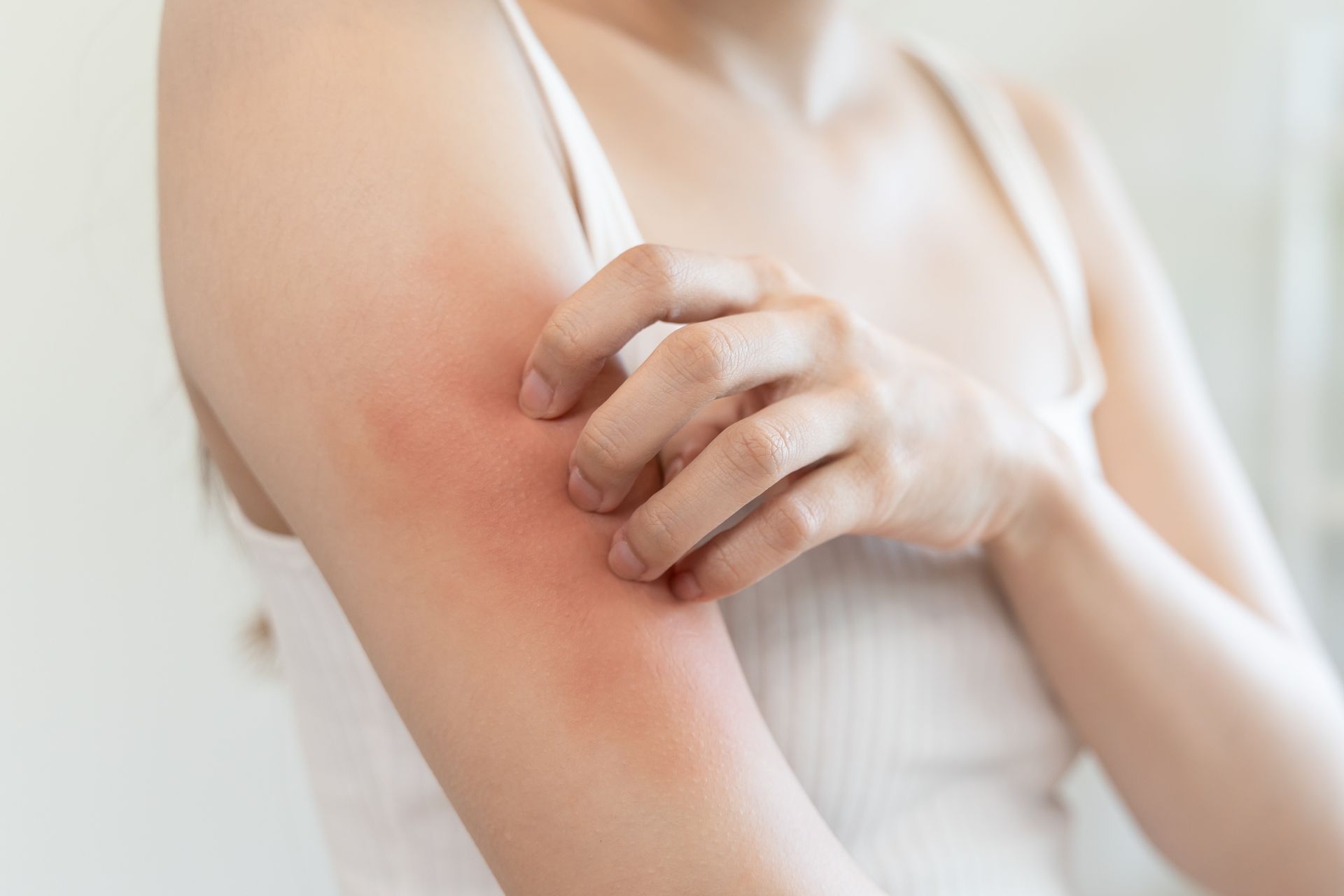 Woman scratching red, irritated skin on her arm, wearing a white tank top.