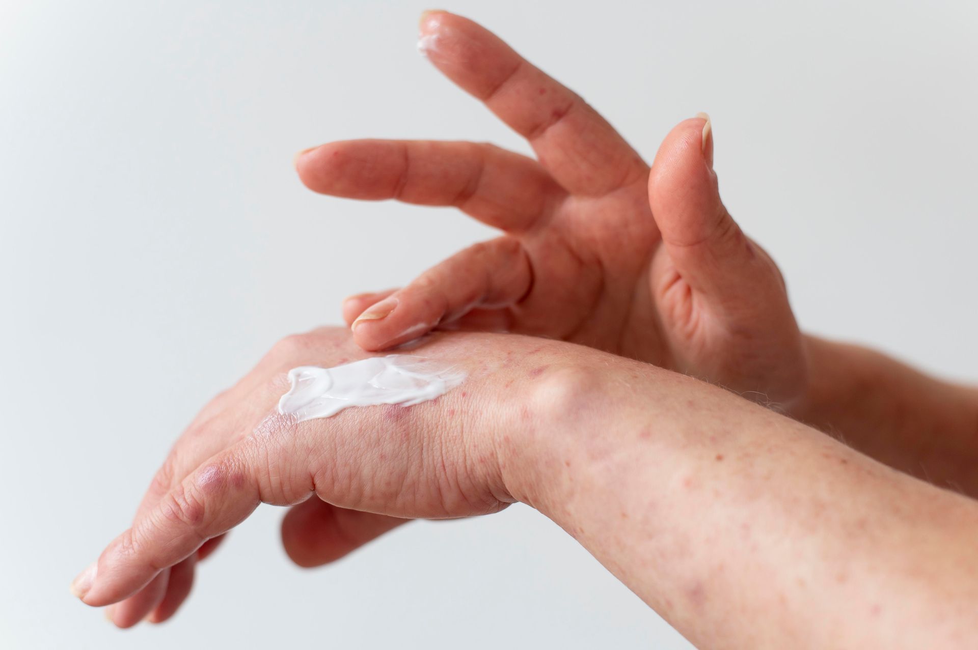 Person applying lotion to their dry hands, cream on palm, against a white background.