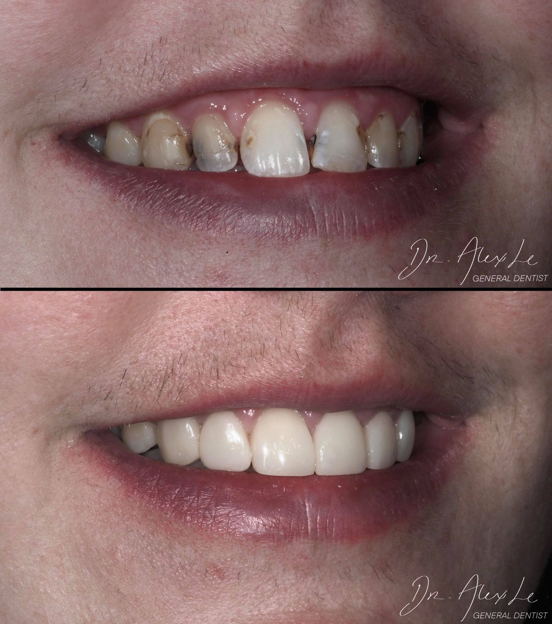 alex veneers