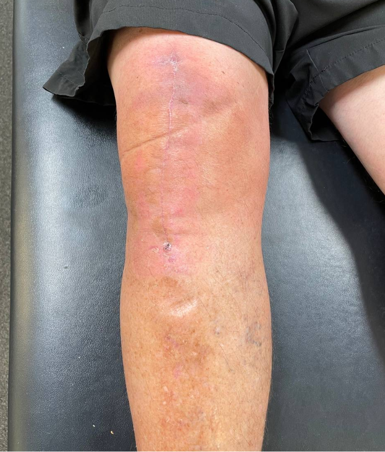 close up of a swollen leg, swelling occuring following an injury