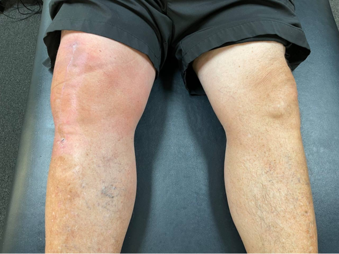 patient suffering from a swollen leg following a surgery or injury, to answer the question why does swelling occur