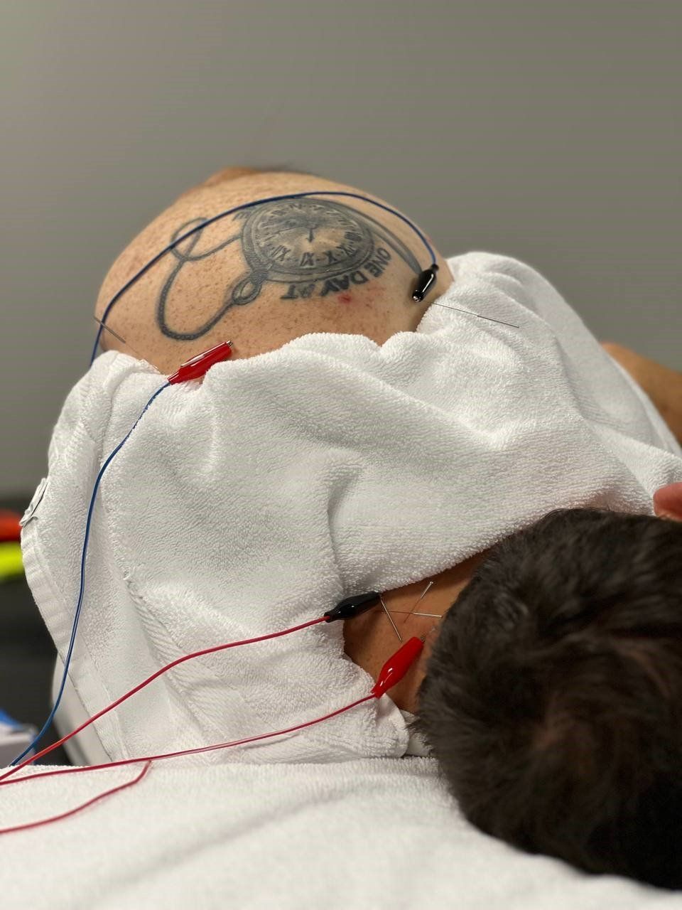 Dry Needling vs Acupuncture Back in The Game Physical Therapy