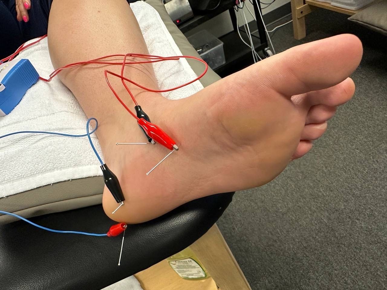 What Is Dry Needling?
