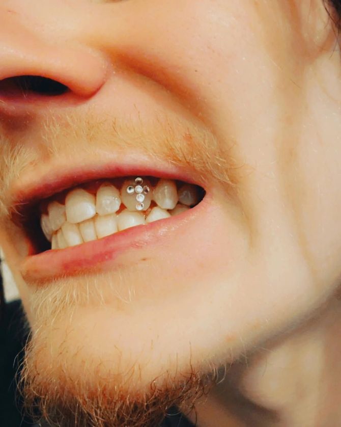 A close up of a man 's mouth with braces on his teeth.