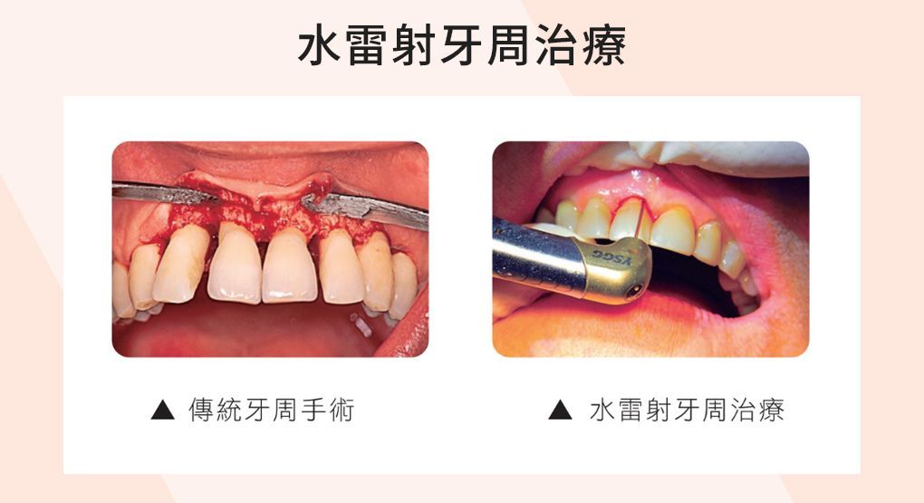 尊兆牙醫家庭牙科療程中，水雷射牙周病治療的示意圖