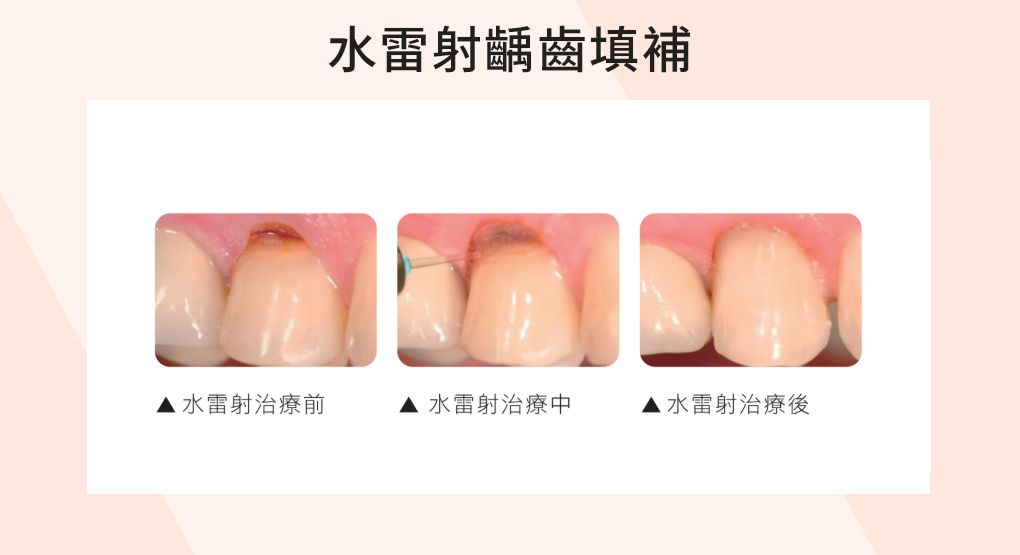 精準齲齒填補—結合水雷射輔助的微創修復